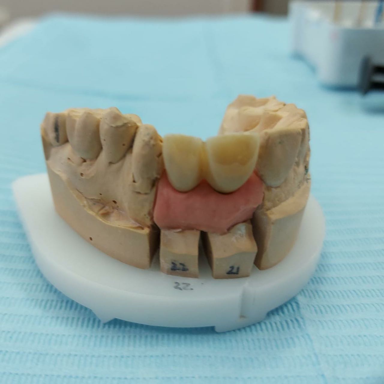 Dental treatment before and after result 4